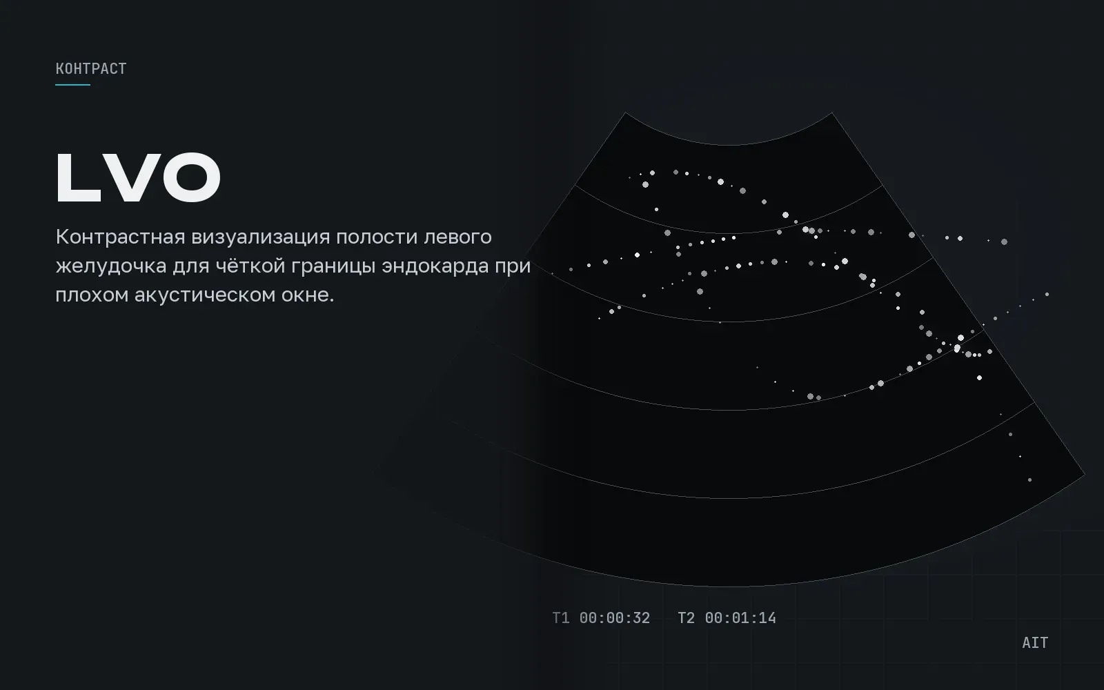 LVO, контрастирование левого желудочка